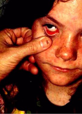 19 children feared killed by measles complications in Adamawa state