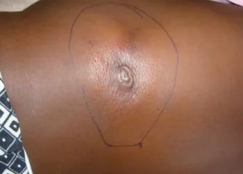 Strange flesh-eating disease hits Adamawa, seven killed, 67 additional cases confirmed